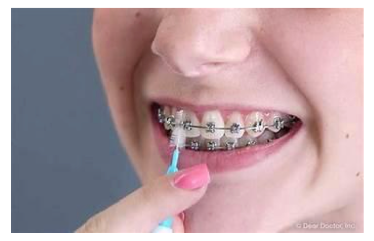 Best Orthodontist near MG Road Bangalore